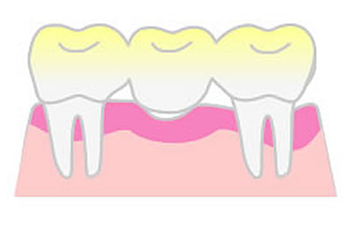 従来の治療法（ブリッジ）の場合