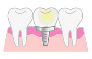 インプラント治療の場合