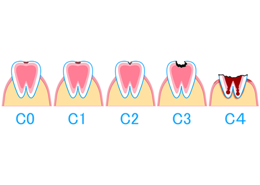 むし歯の進行