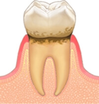 歯肉炎