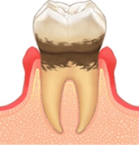 歯肉炎（軽度）